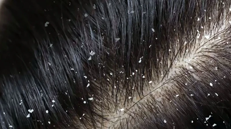 Interpreting Dandruff Colors